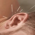 The Power of Acupuncture: A Natural Medicine for Somatic Tinnitus