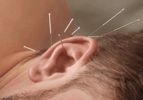 The Power of Acupuncture: A Natural Medicine for Pulsatile Tinnitus