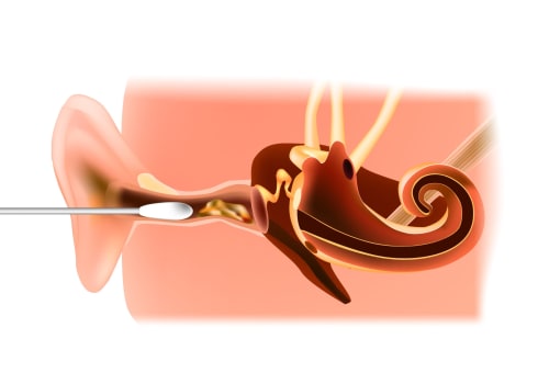 Natural Remedies for Tinnitus Caused by Earwax Buildup